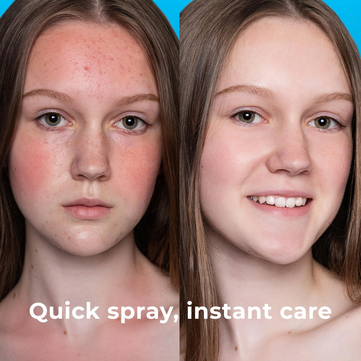PatchRx being sprayed on face for quick blemish and redness relief