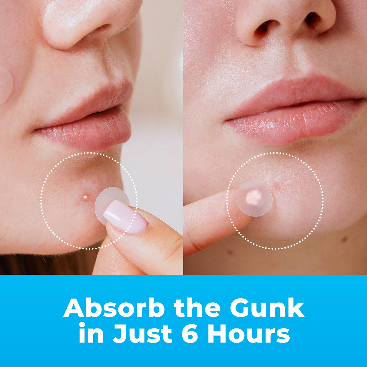PatchRx close-up of hydrocolloid dot texture highlighting absorbent surface