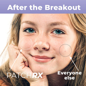 PatchRx multiple patches on forehead protecting and treating spots
