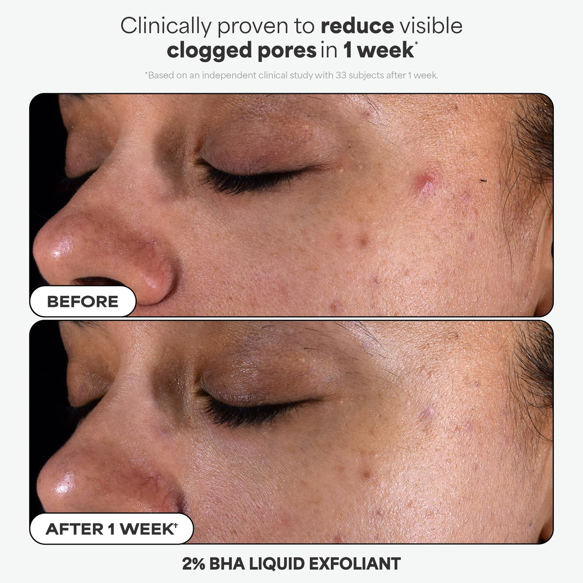 Paula's Choice 2% BHA liquid close-up bottle emphasizing exfoliation results