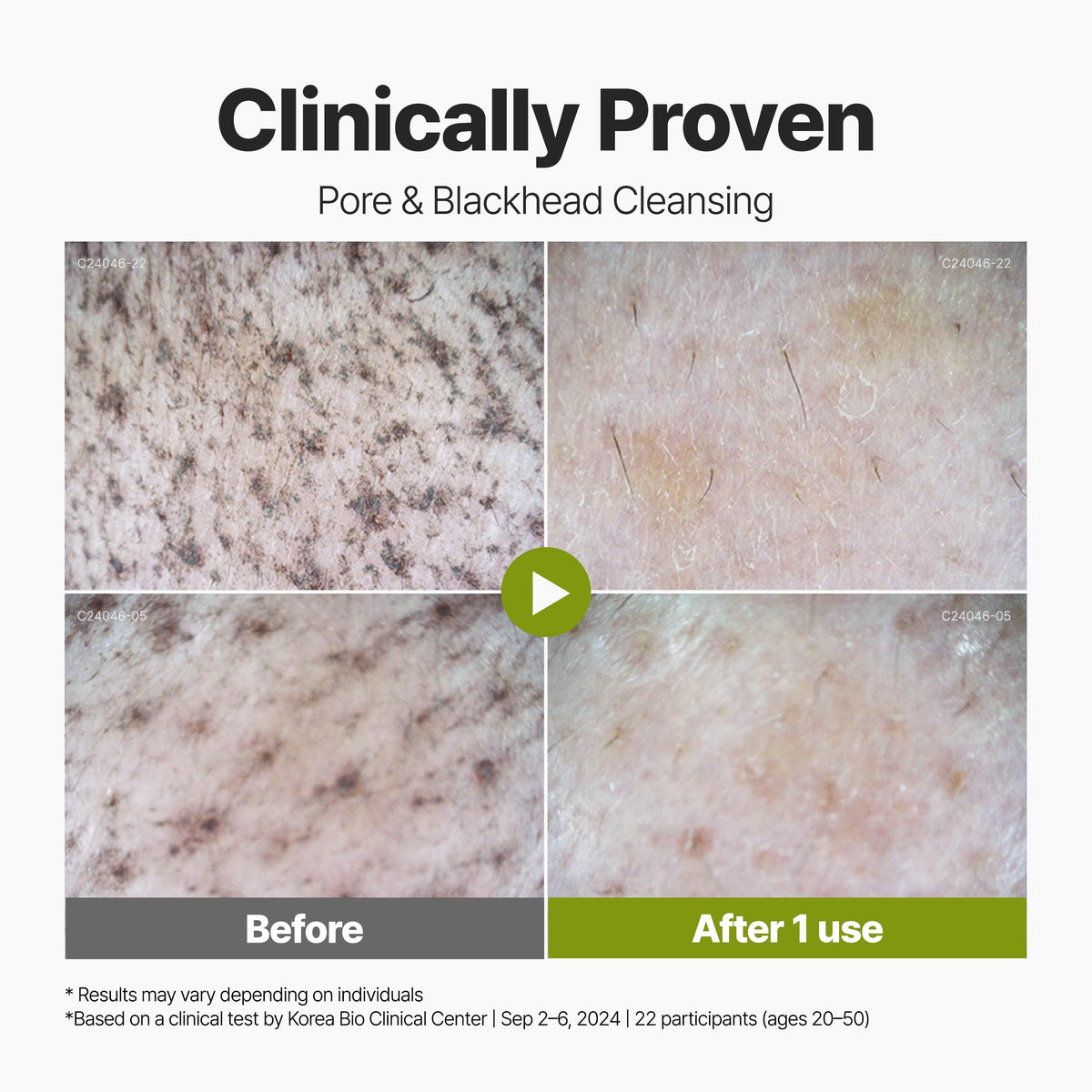 P.CALM being applied to face highlighting pore-cleansing effect