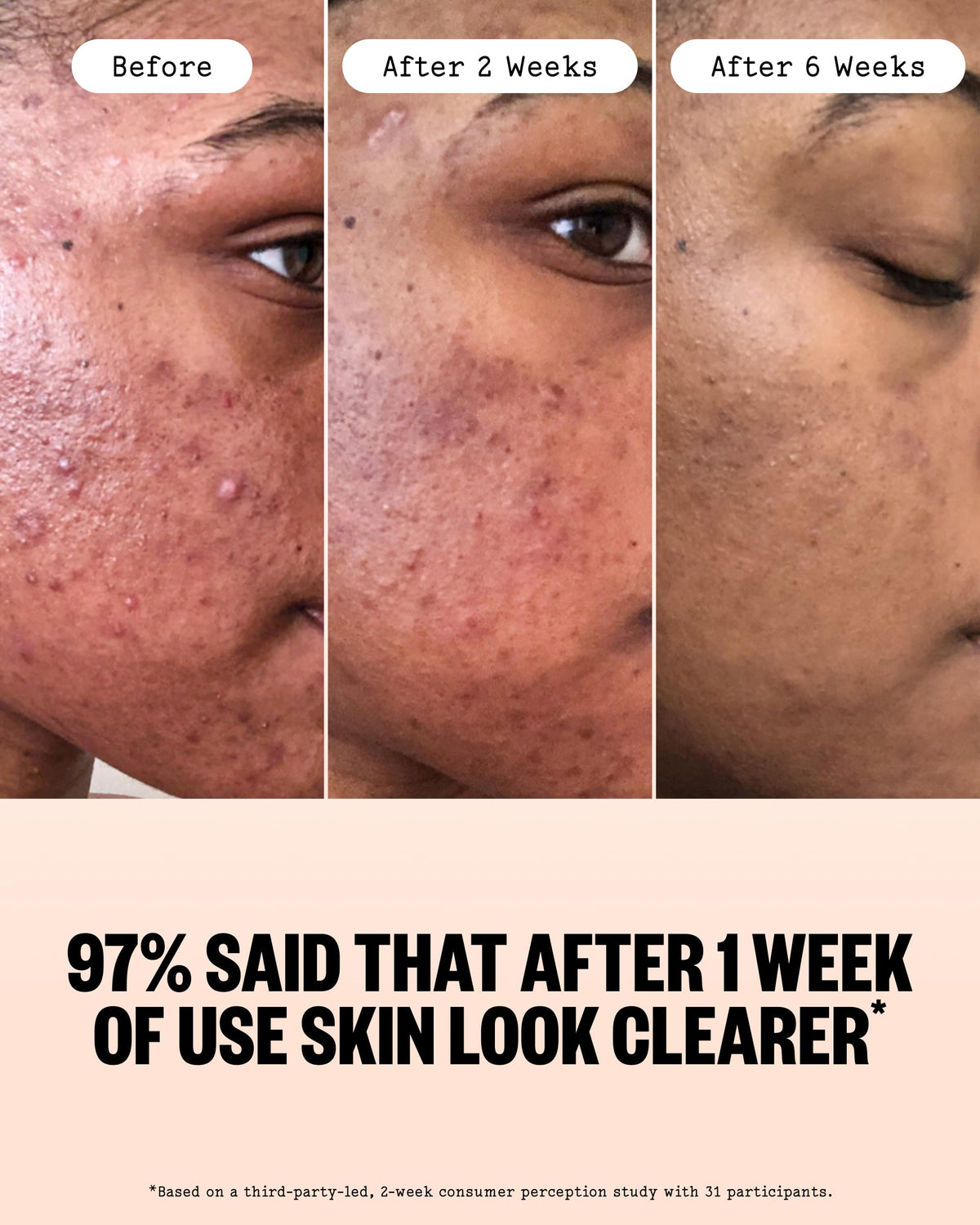 PEACE OUT ingredient label showing actives like 2% salicylic acid and niacinamide benefits