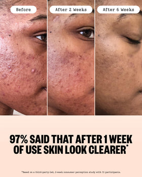 PEACE OUT ingredient label showing actives like 2% salicylic acid and niacinamide benefits