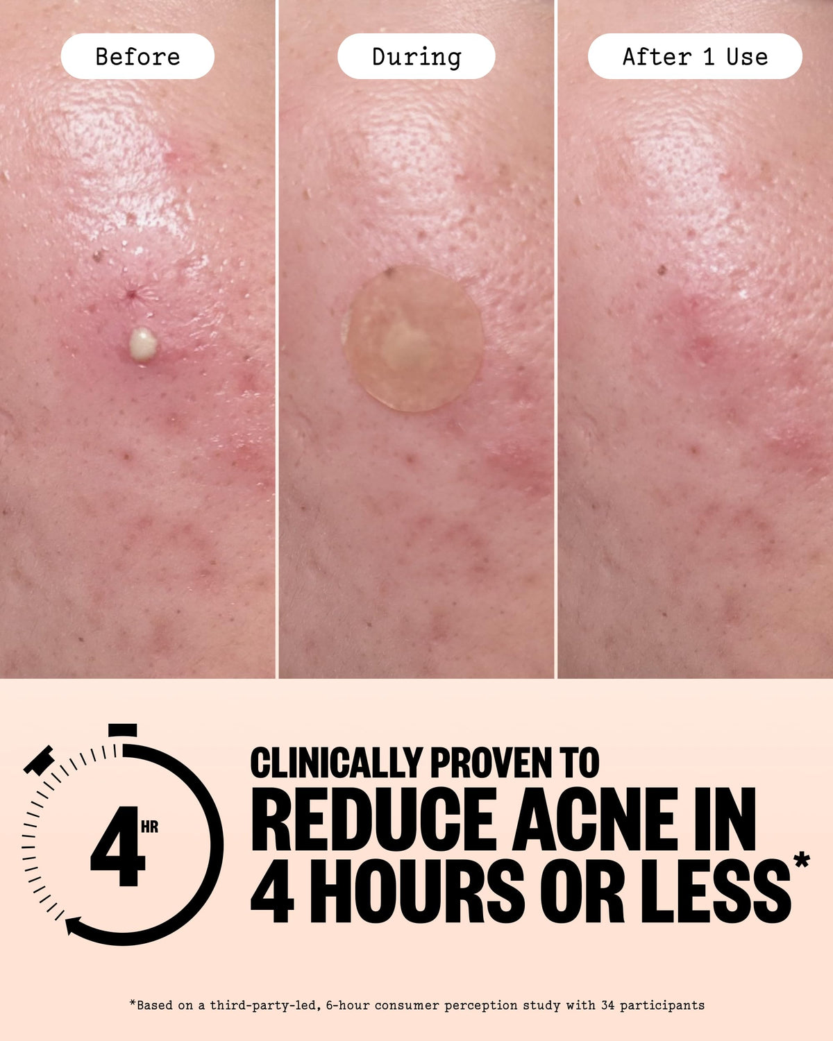 PEACE OUT single healing dot applied to cheek demonstrating targeted treatment
