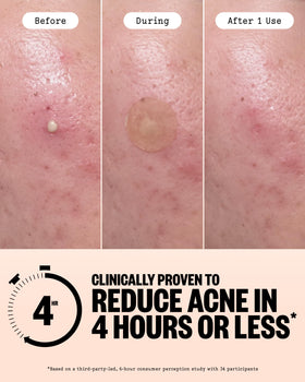 PEACE OUT single healing dot applied to cheek demonstrating targeted treatment