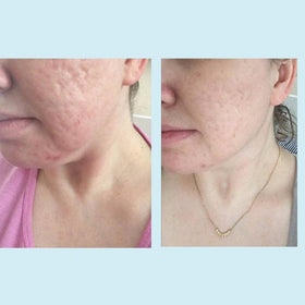 Perfect Image before and after skin texture comparison showing refinement