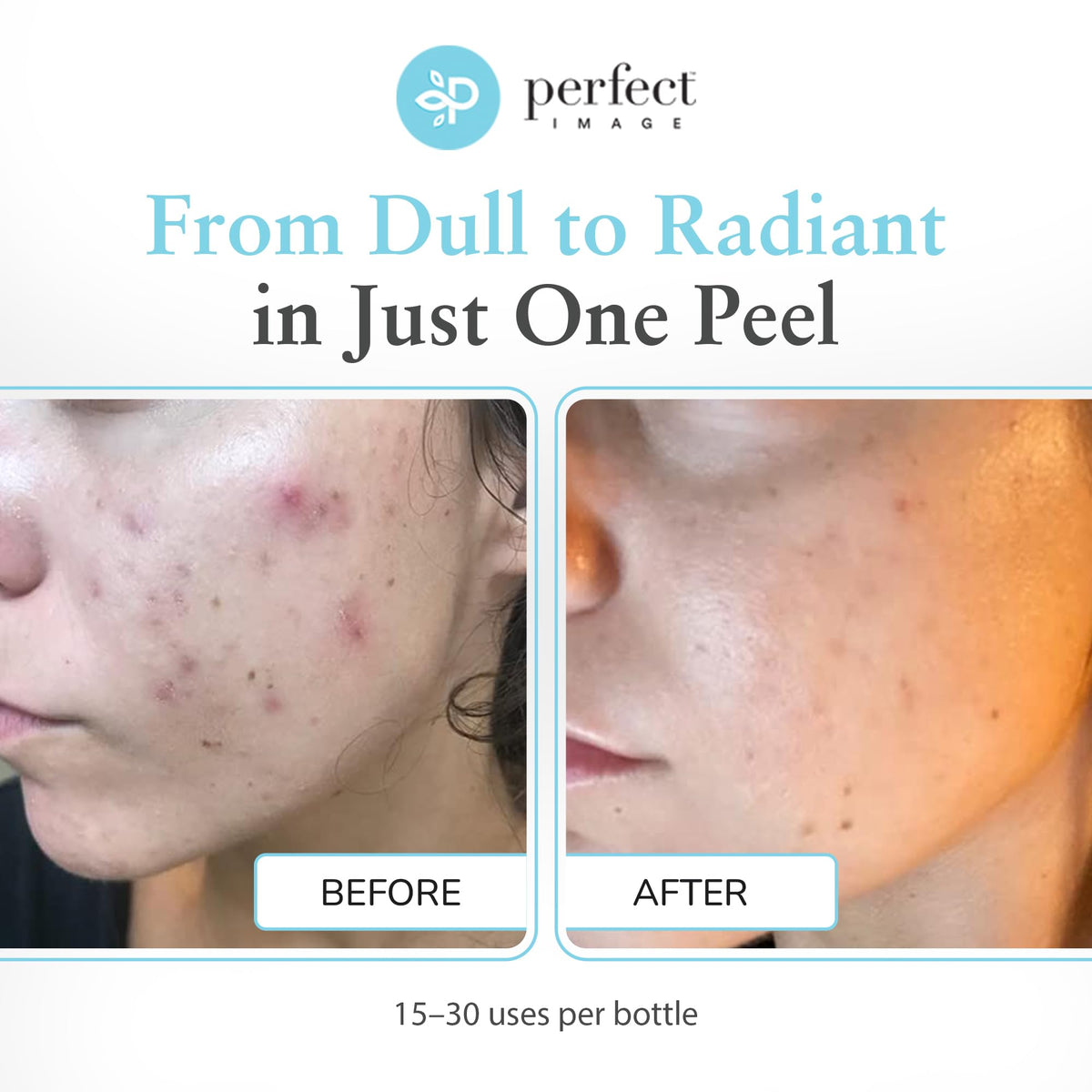 Perfect Image peel applied on hand demonstrating controlled application