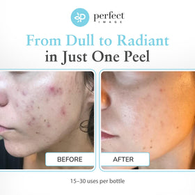 Perfect Image peel applied on hand demonstrating controlled application