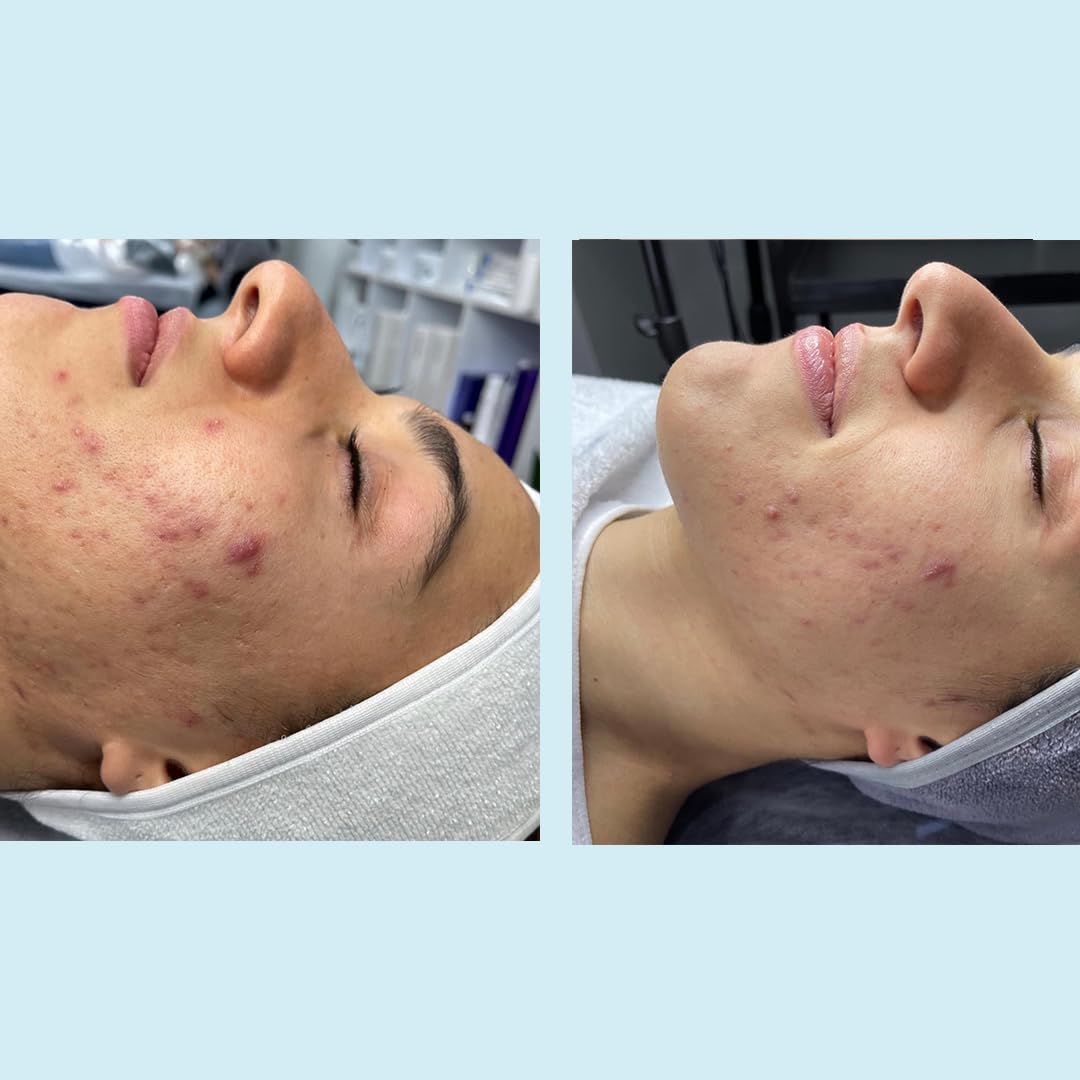 Perfect Image after rinse on cheek illustrating smoother, refined-looking skin