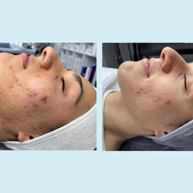 Perfect Image after rinse on cheek illustrating smoother, refined-looking skin