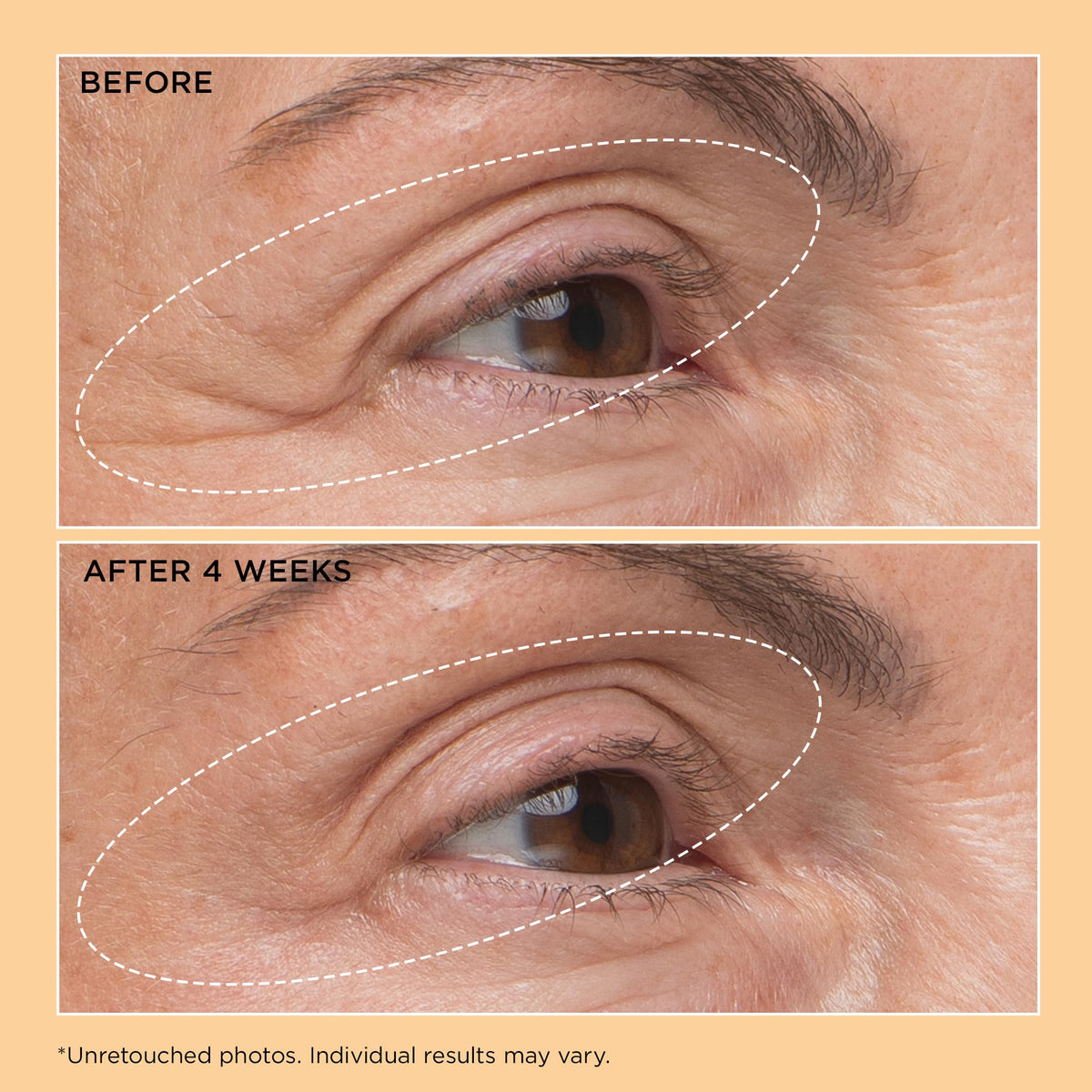 Perricone MD before and after visual illustrating improved eyelid texture