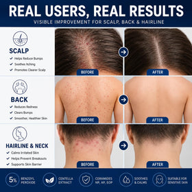 Peunitory applying cream to scalp showing spot treatment and reduced residue