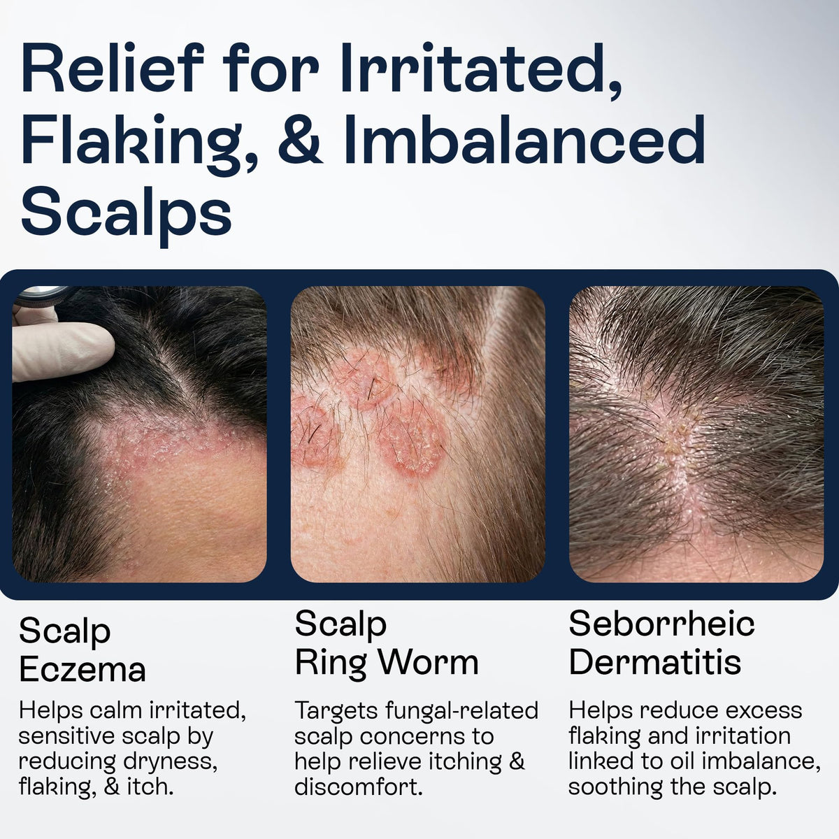 Pharmlitalia applying spray at hairline to soothe flakes and itching