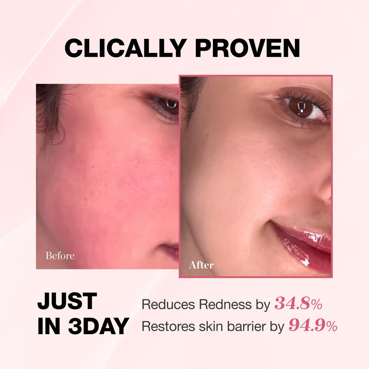 PHYSIOGEL cream applied on hand illustrating instant calming hydration