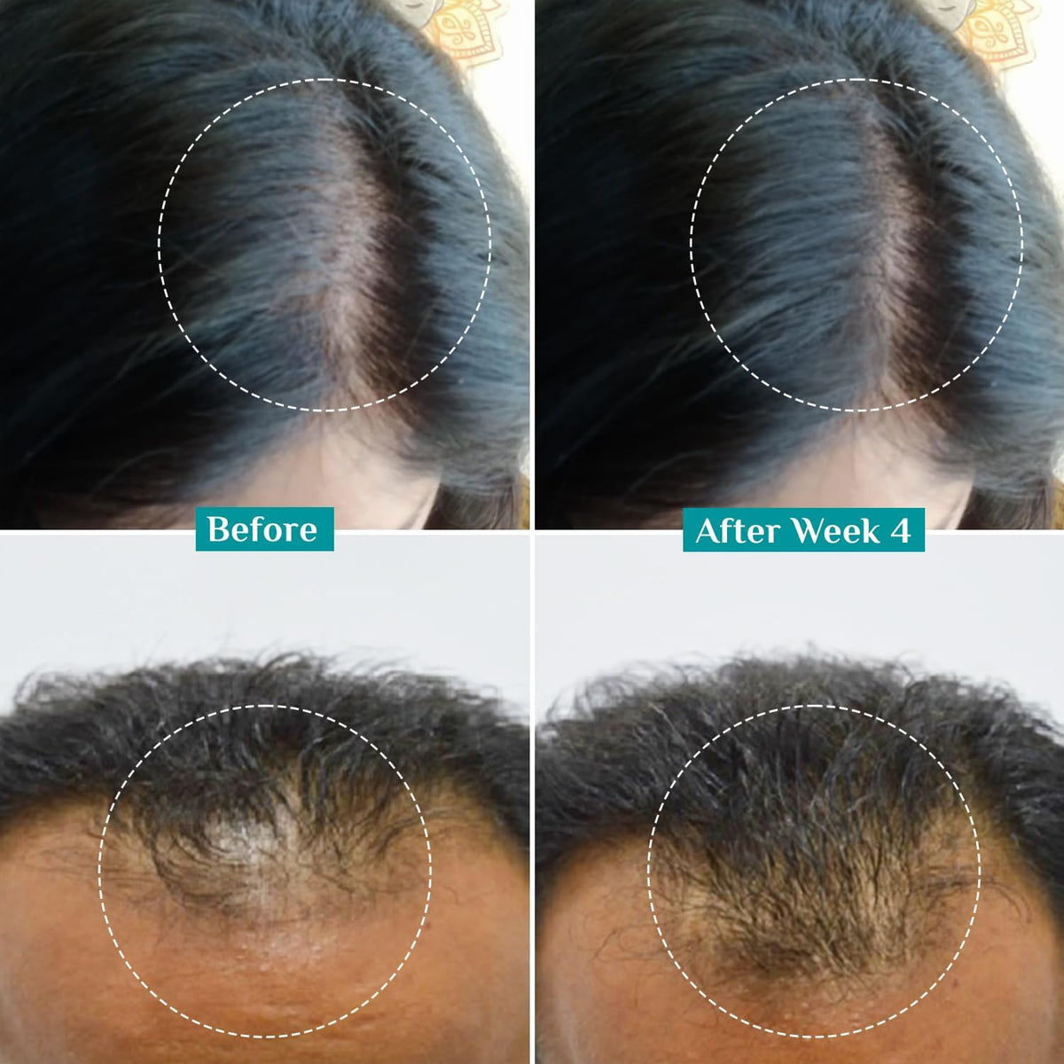 Pilgrim applying serum to scalp, supports targeted follicle nourishment benefit