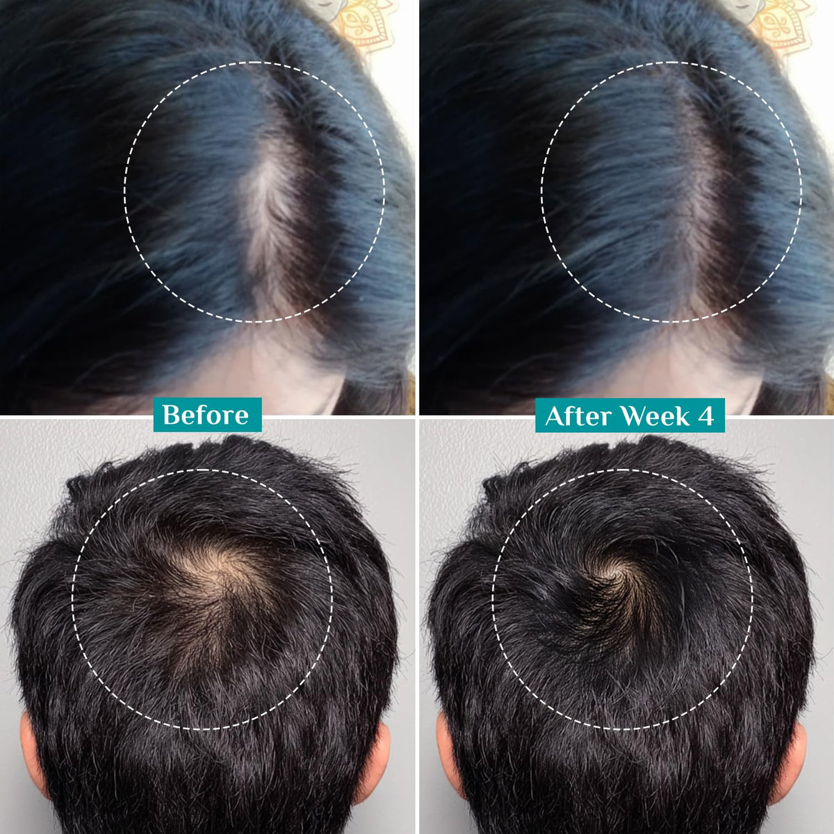 Applying Pilgrim serum to scalp to target thinning areas and stimulate follicles
