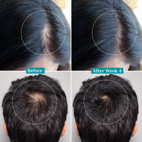 Applying Pilgrim serum to scalp to target thinning areas and stimulate follicles