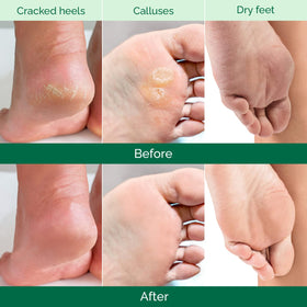 PLANTIFIQUE foot mask in use with booties applied for hands-free treatment