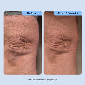 Plexaderm application on neck demonstrating targeted smoothing benefit