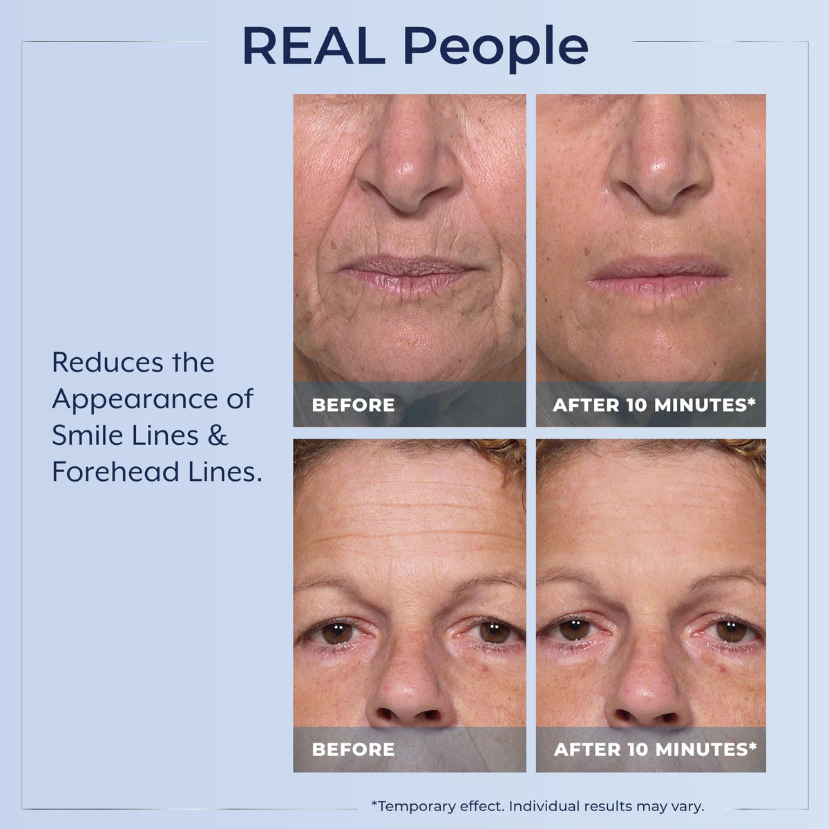 Plexaderm being applied under-eye to reduce bags and smooth skin