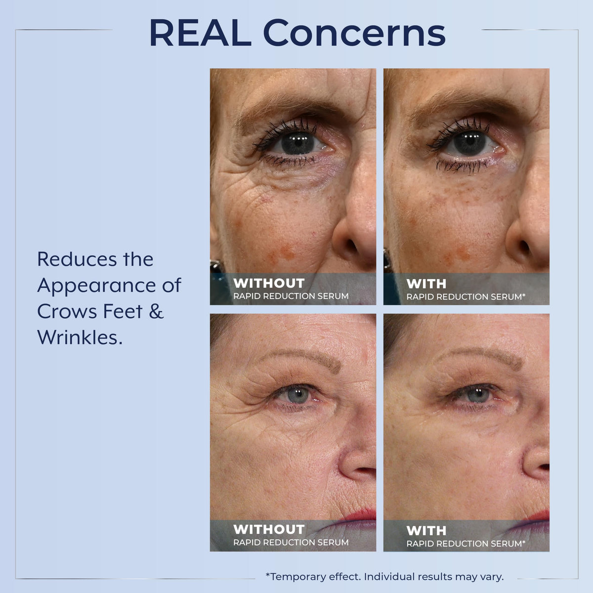 Plexaderm before and after comparison demonstrating visible tightening