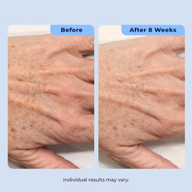 Plexaderm size comparison in hand showing travel-friendly benefit