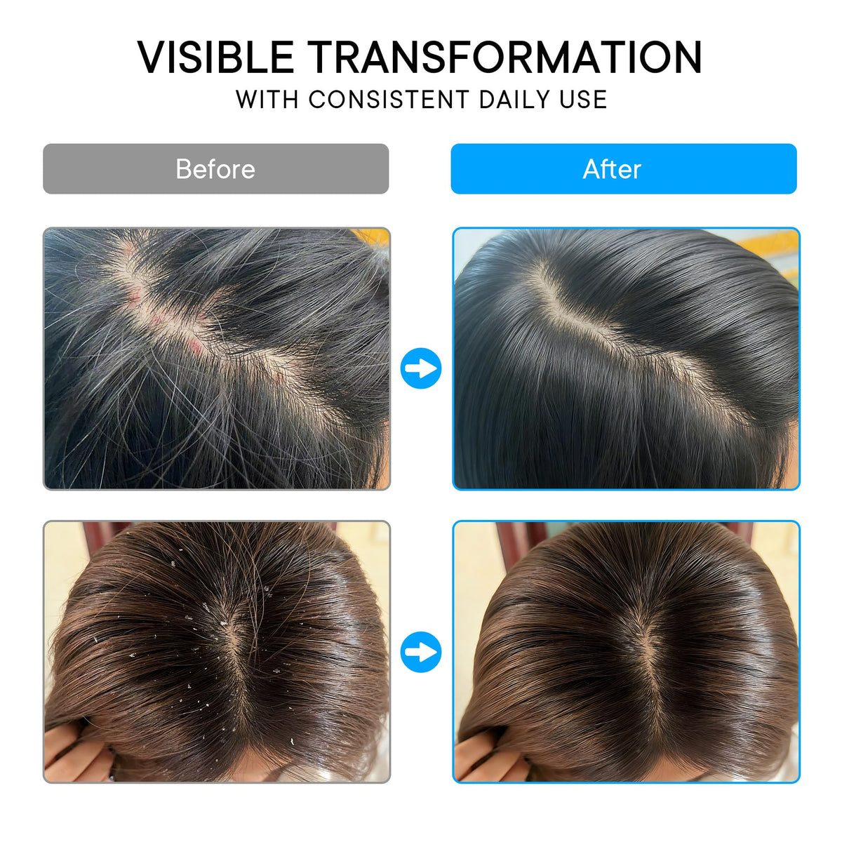 Illustrative before and after scalp schematic with ProBliva for visible flake reduction