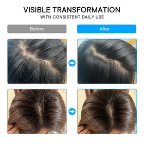 Illustrative before and after scalp schematic with ProBliva for visible flake reduction