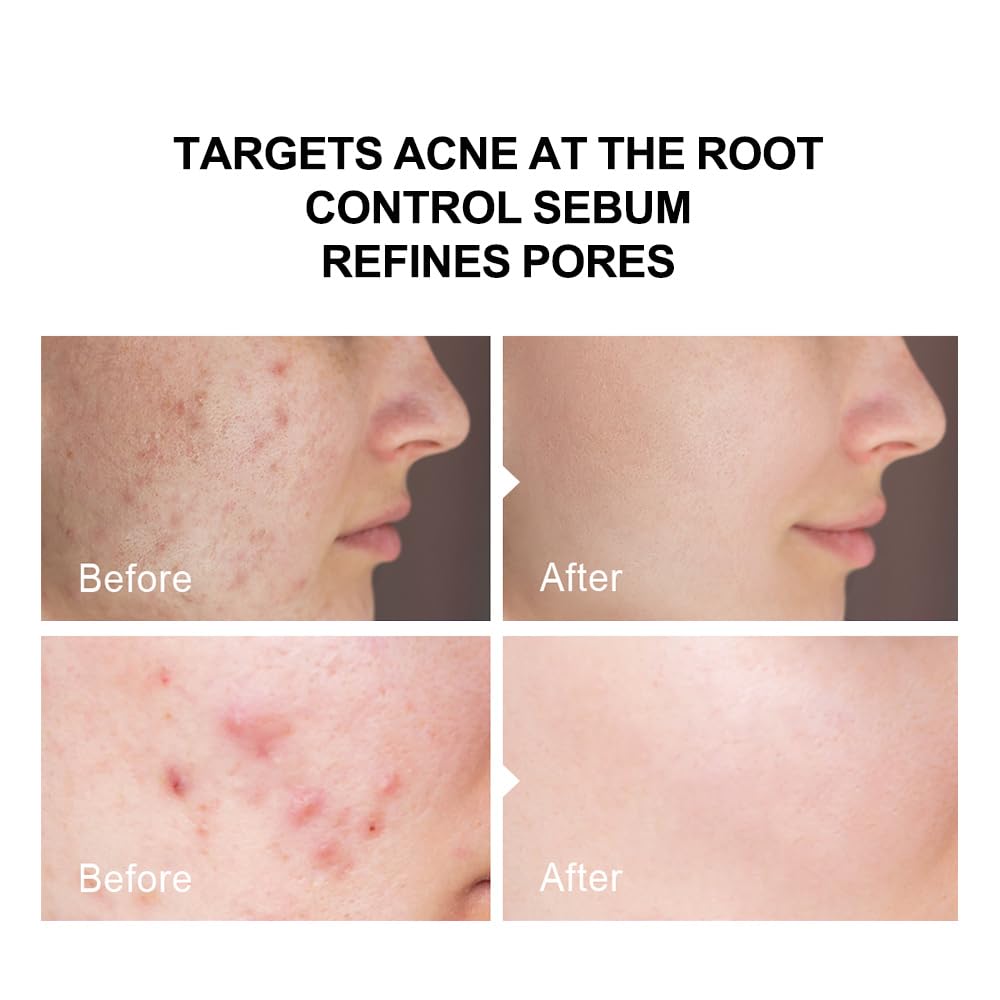 pure.tiful applying serum to back showing treatment for body acne benefit