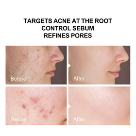 pure.tiful applying serum to back showing treatment for body acne benefit