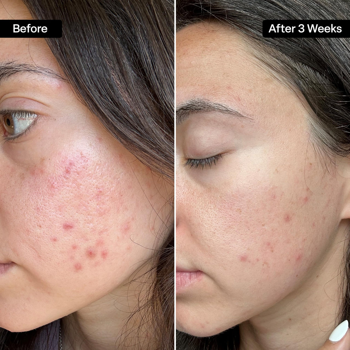 QRxLabs pad in hand applying to face for quick treatment