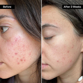 QRxLabs pad in hand applying to face for quick treatment