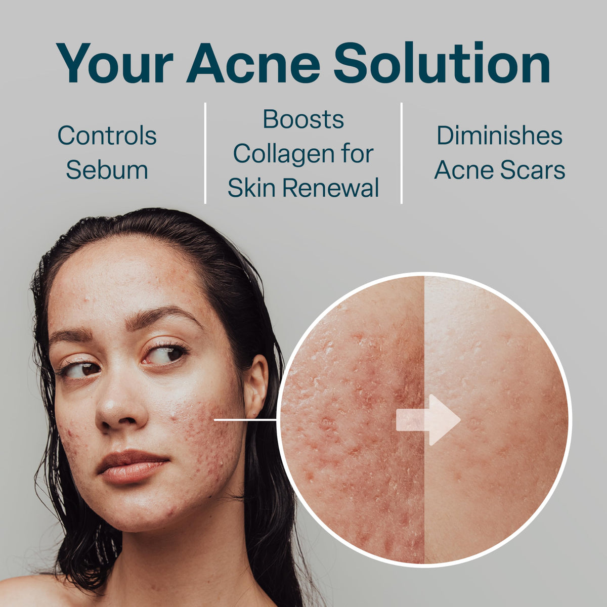 QRxLabs pad used on back targeting bacne and body acne