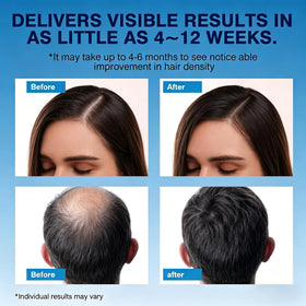 Quilom foam applied to beard area to encourage fuller facial hair