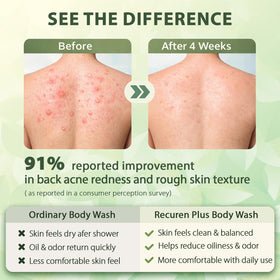Recuren Plus used in shower on back acne area for targeted cleansing