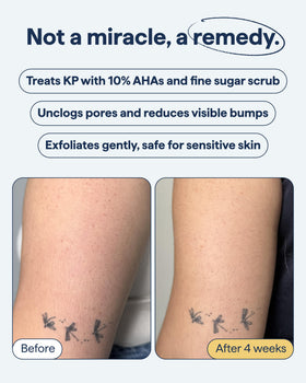 Remedy Science product in shower being used on upper arm for bumps
