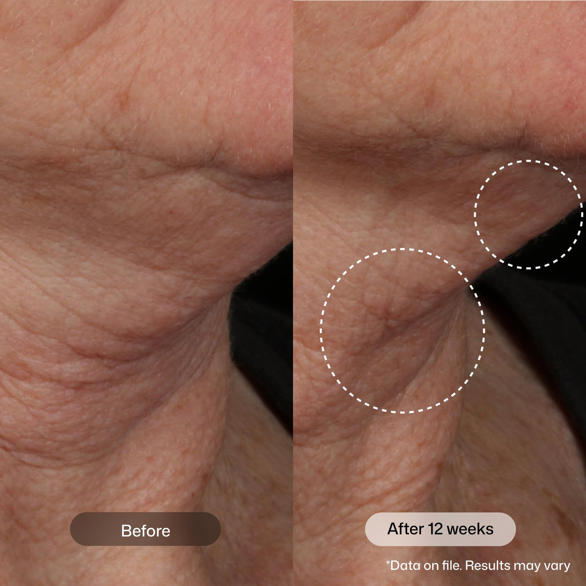 Revision Skincare Nectifirm Advanced being applied to neck to lift and smooth skin