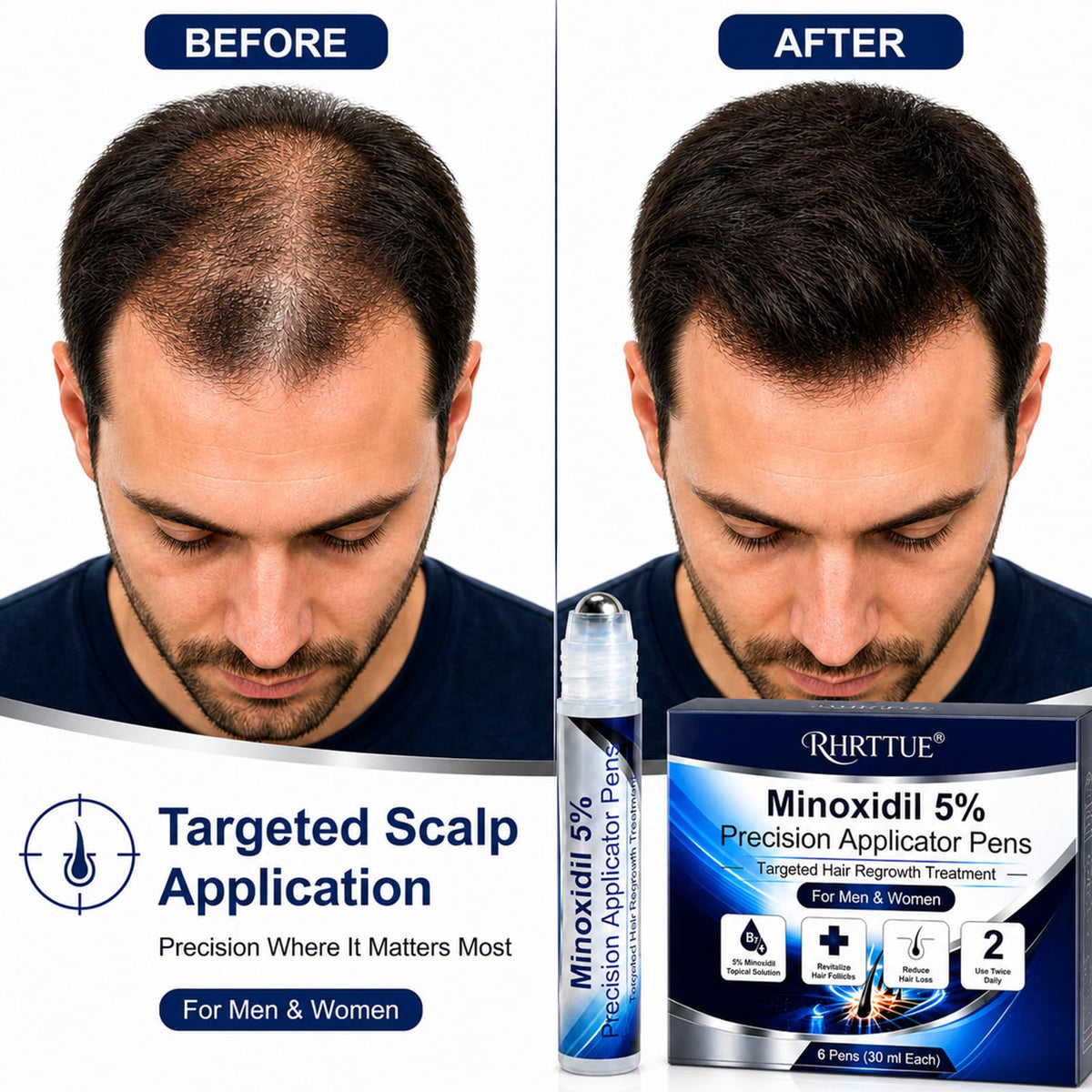 RHRTTUE targeted application on thinning scalp delivering precise placement benefit
