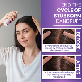 Rida Hair Research Neoketramin applied to scalp showing targeted relief and comfort