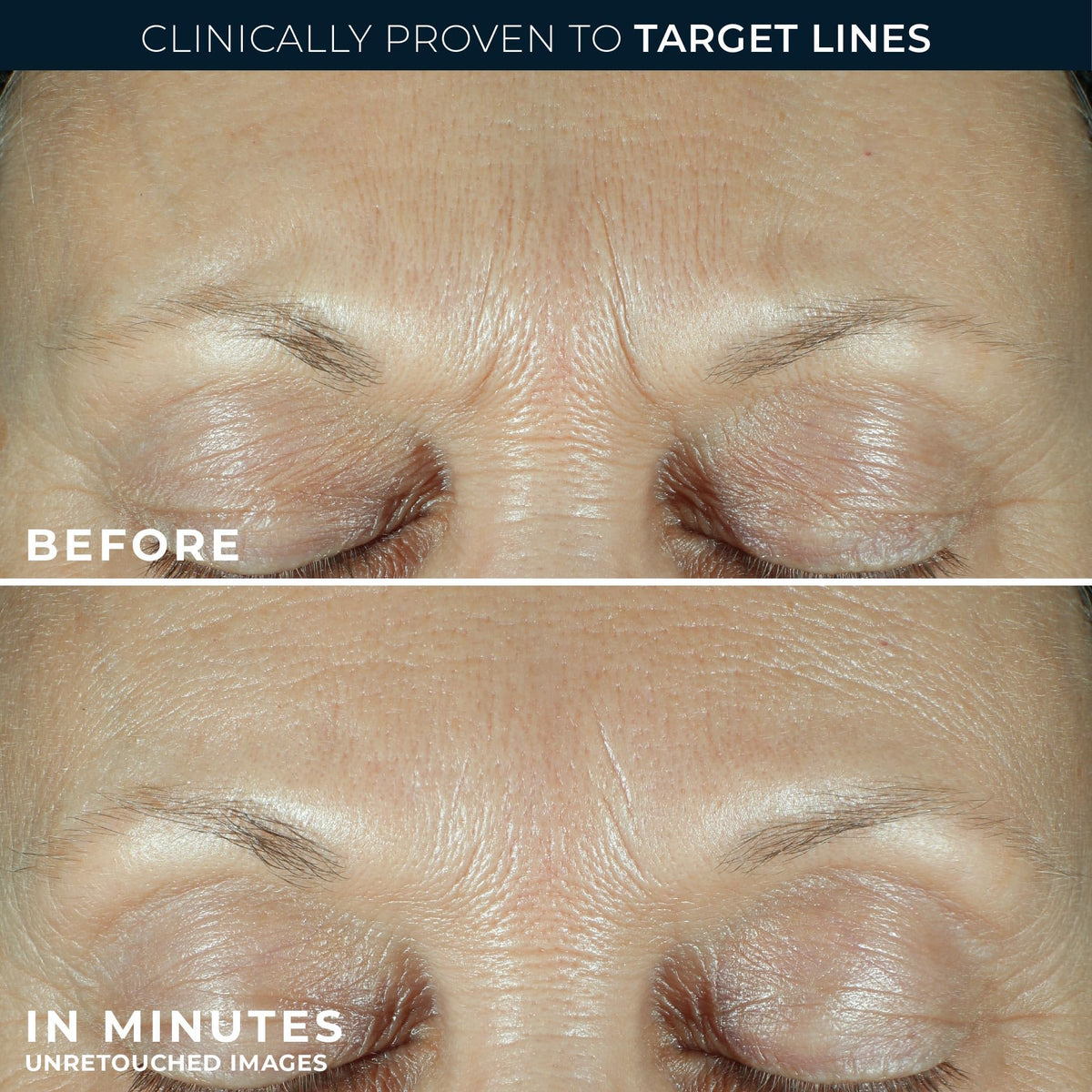 RoC application on crow's feet showing targeted wrinkle treatment benefit