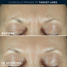 RoC application on crow's feet showing targeted wrinkle treatment benefit