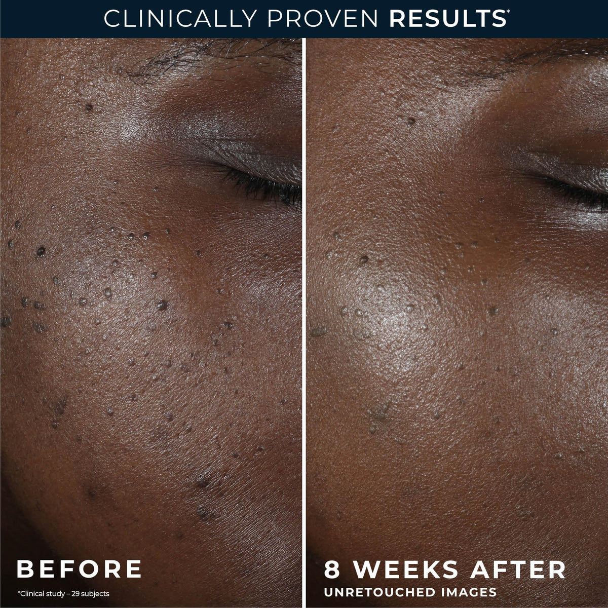 RoC before and after on face showing reduced discoloration and brighter tone