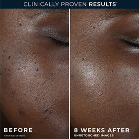 RoC before and after on face showing reduced discoloration and brighter tone