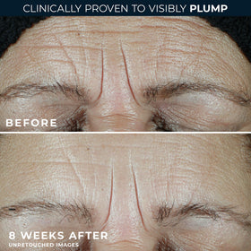 RoC before and after visual illustrating improved skin appearance
