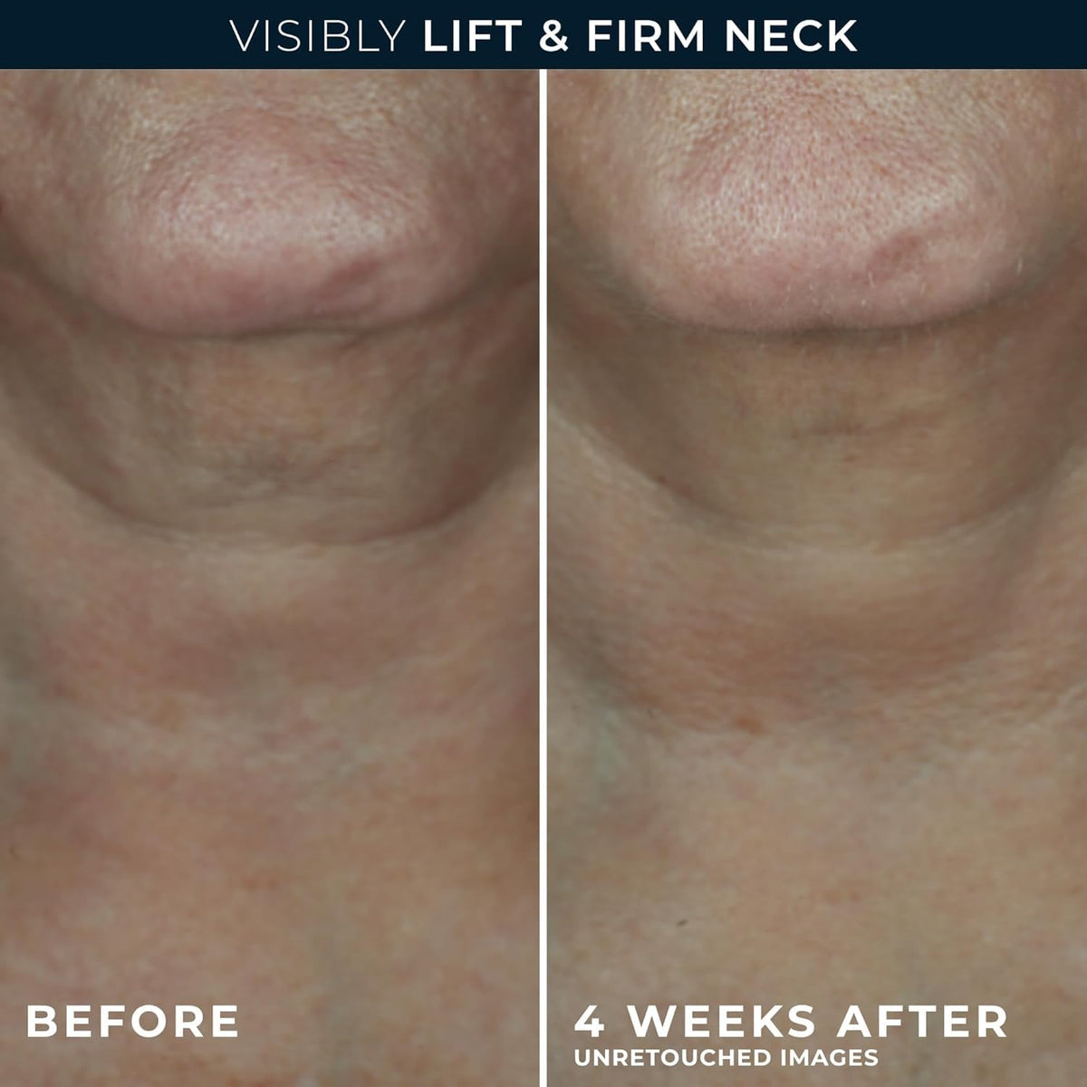 RoC neck cream dispensed amount on fingertip for proper dosing