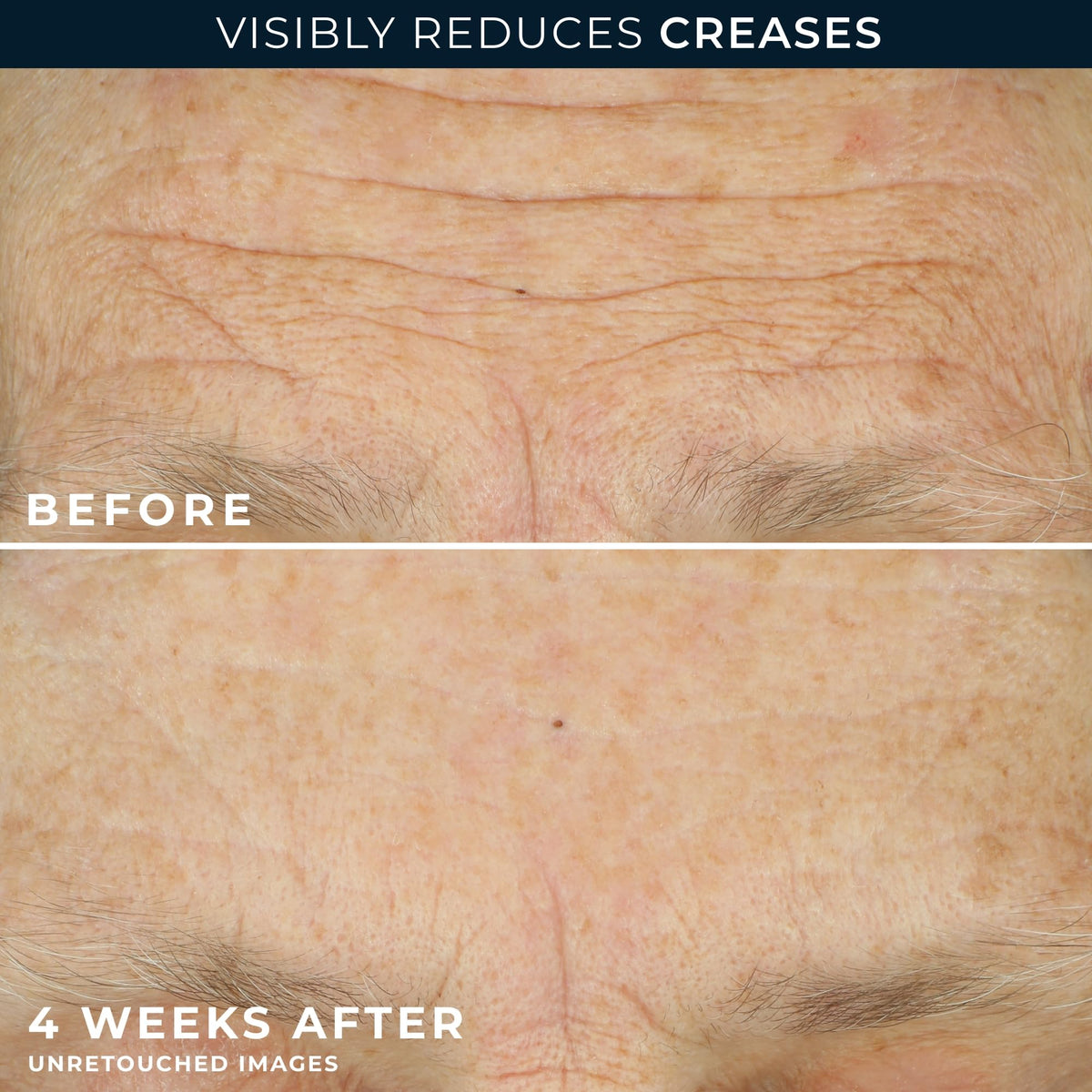 RoC retinol capsule open to show single measured retinol dose