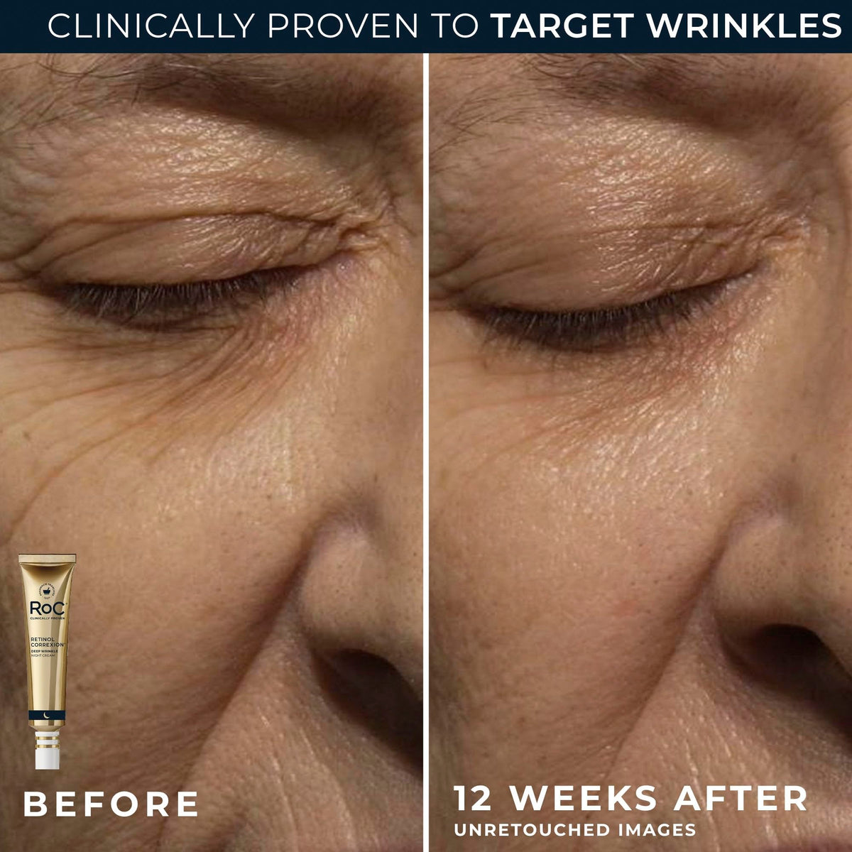 RoC eye cream applied beneath eye, reduces puffiness and brightens look