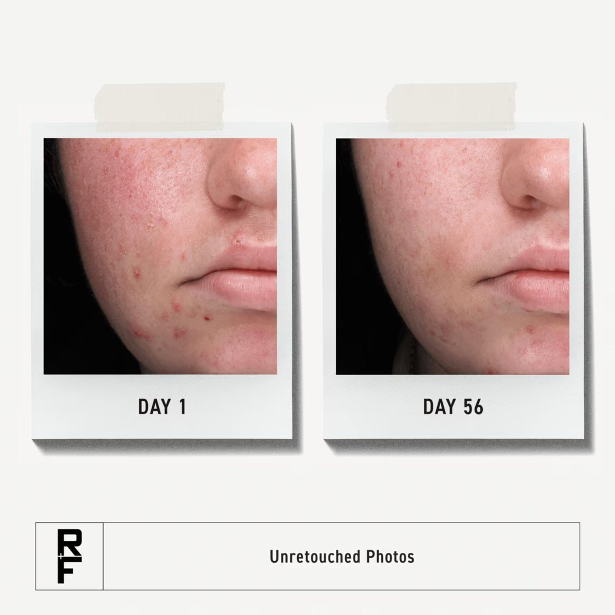 Rodan + Fields benzoyl peroxide cleanser texture close-up for deep pore cleansing benefit