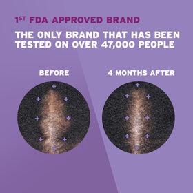 Hand applying Rogaine foam to scalp demonstrating easy once‑daily use
