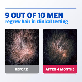 Rogaine applied to top of scalp illustrating targeted regrowth support